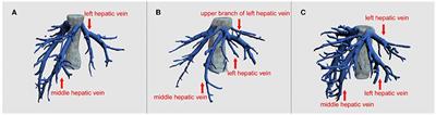 Comparison of Two Donor Liver Procurement Methods for Treatment of Pediatric Acute Liver Failure